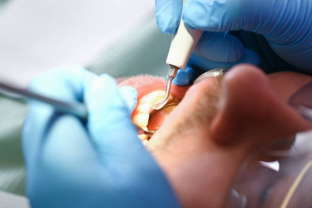 Best Emergency Dental Care for Broken or Chipped Teeth in Pelion, SC